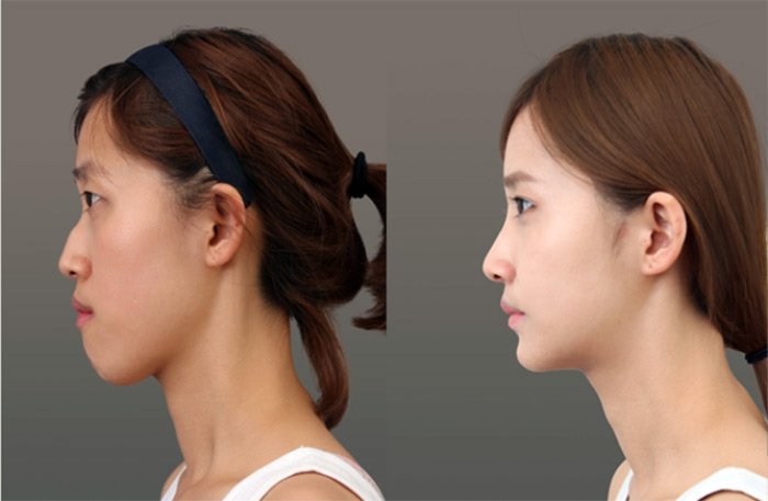 Chirurgie plastique photos avant et après