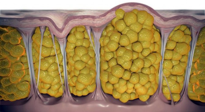 Comment se débarrasser de la cellulite à la maison