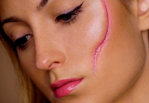 Enlèvement des cicatrices avec laser et remèdes populaires