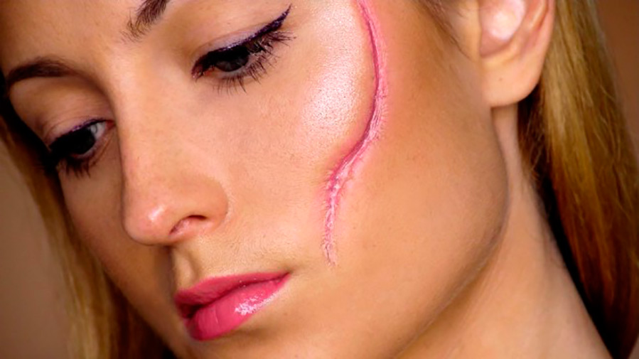 Élimination des cicatrices au laser