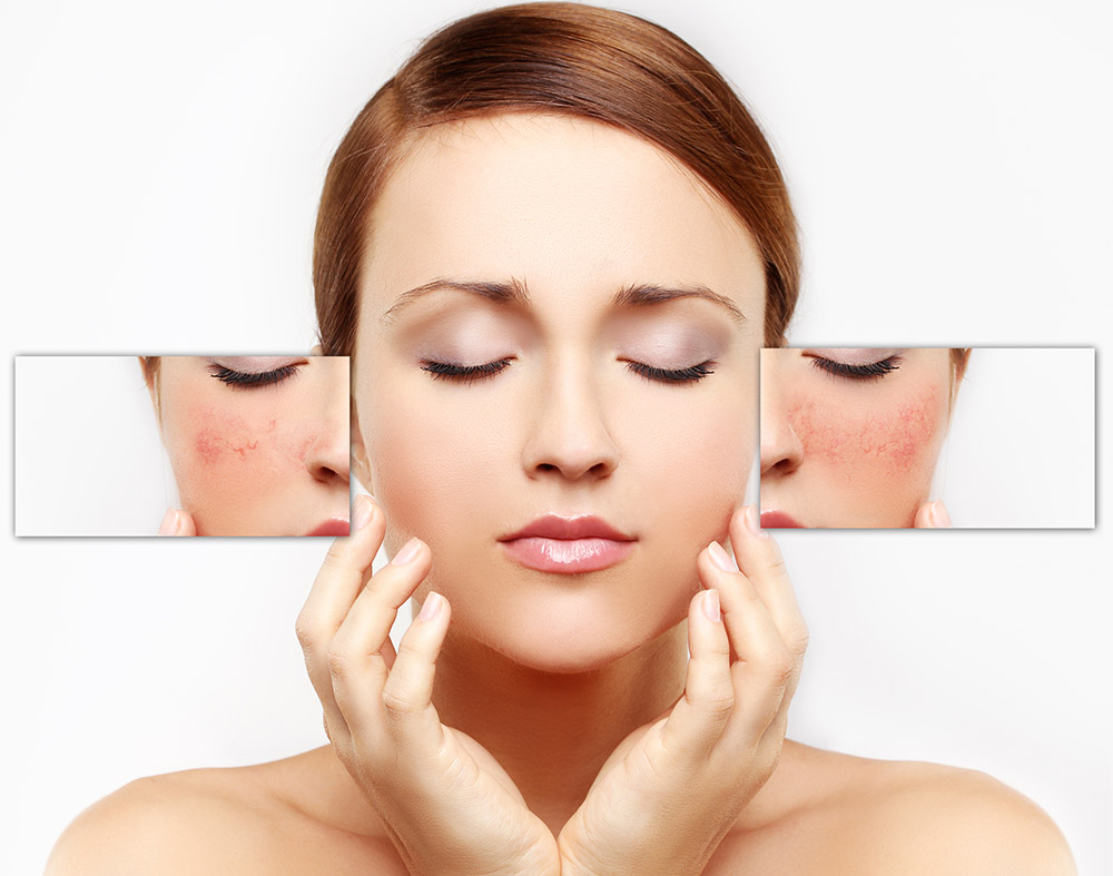 Traitement de l'acnée