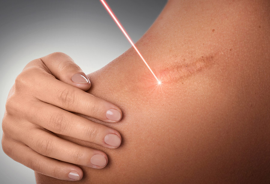 Comment se débarrasser des cicatrices après la chirurgie