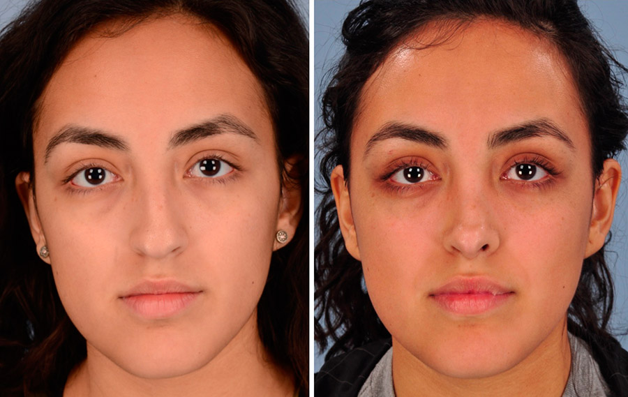 Quand faire une rhinoplastie
