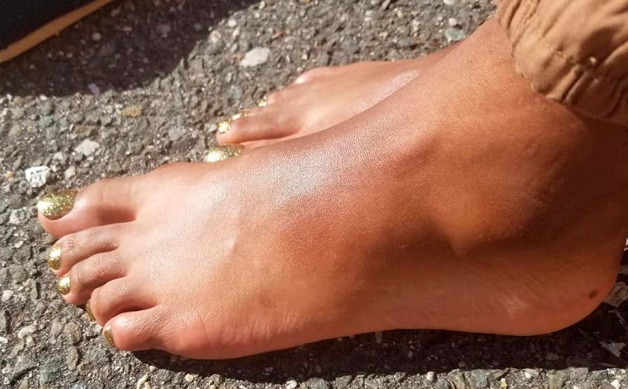 remèdes contre l'enflure et la fatigue des jambes